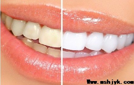 牙齿瓷贴面的优点有哪些？