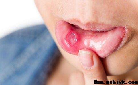 口腔扁平苔藓危害大 如何有效预防