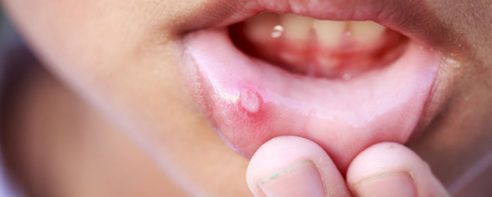 口腔溃疡是什么缘故原由引起的 口腔溃疡怎么治